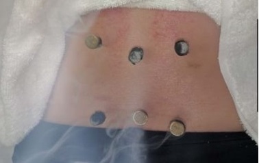 GTA Pain Rehab Centre-moxa treatment