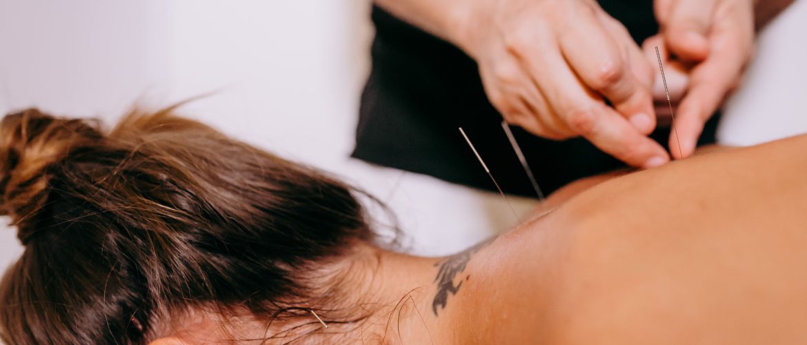 Close-up of acupuncture needles being inserted on a woman's back during therapy, promoting relaxation and wellness.